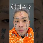顔面ニキさんタトゥー除去経過見せます‼️#shorts