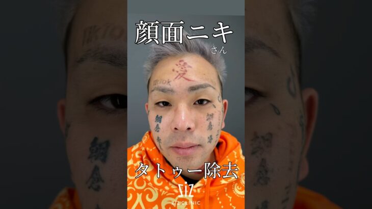 顔面ニキさんタトゥー除去経過見せます‼️#shorts